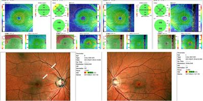 Case report: Findings of automated perimetry during a migraine episode in a patient with glaucoma
